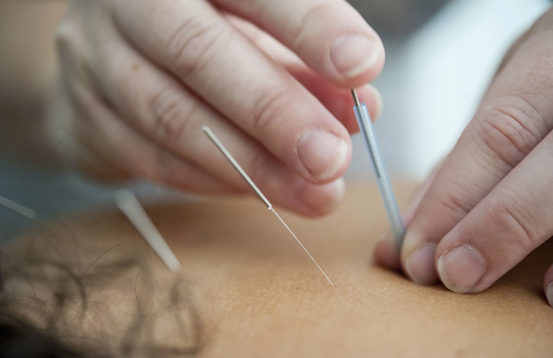 $95 Première visite - Séance d'acupuncture