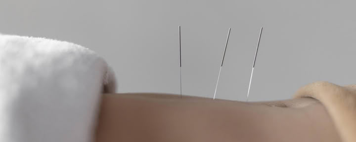 Acupuncture